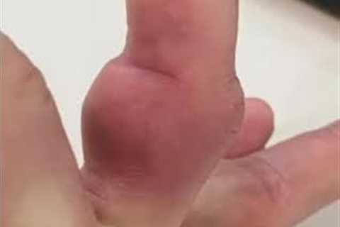 UFC star Michael Chandler shows off gruesomely deformed bulging dislocated finger after Tony..