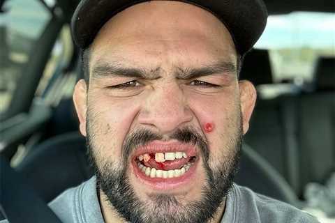 UFC star Kelvin Gastelum has his teeth stitched back into gums in graphic video after being forced..