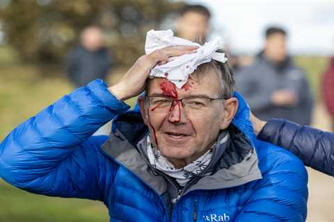 Spectator left covered in blood after Tommy Fleetwood’s ball strikes him on head at Dunhill..