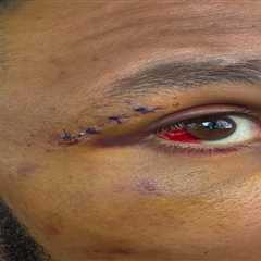 EXCLUSIVE: EUBANK JR REVEALS HORROR EYE INJURY AFTER BLOODY BOUT!