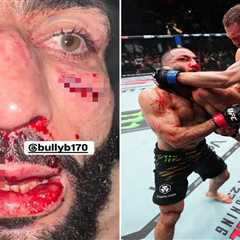 EXCLUSIVE: Bloody Brawl! UFC Champion Left with Split Lip After Gruesome Defeat!