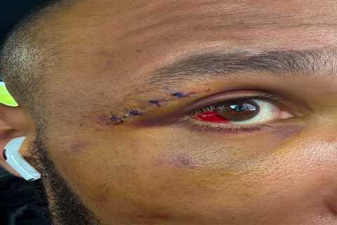 EXCLUSIVE: EUBANK JR REVEALS HORROR EYE INJURY AFTER BLOODY BOUT!